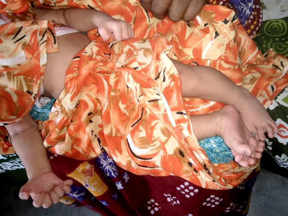 ফুলবাড়ীতে ২৮ আঙুল নিয়ে নবজাতকের জন্ম